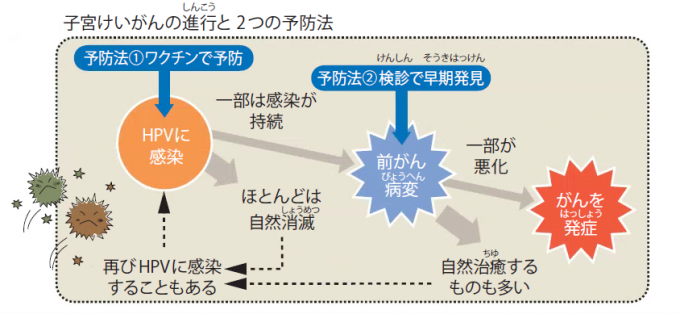 イラスト：子宮けいがんの進行と2つの予防法イメージ