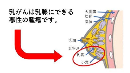 乳がんは、乳腺にできる 悪性の腫瘍です。